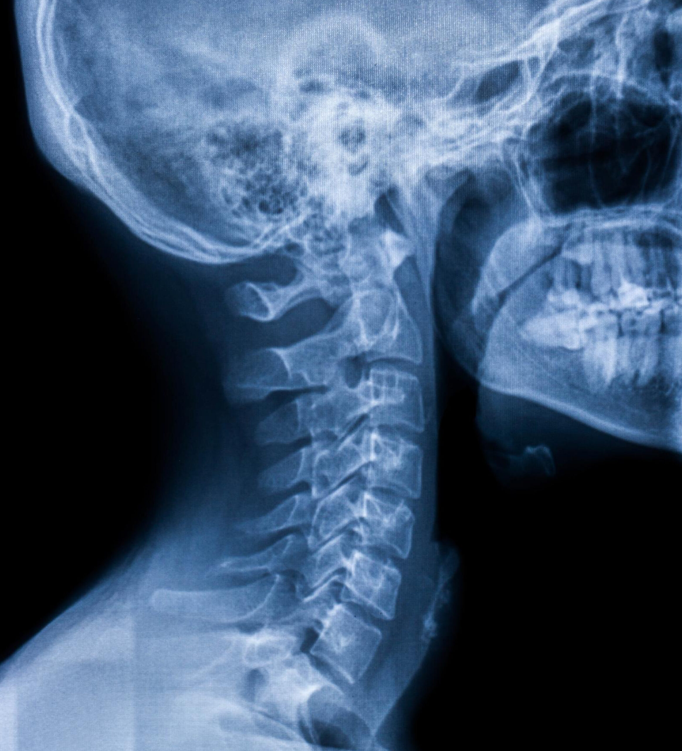 Radiografía de columna cervical o atlas-axis frontal y lateral