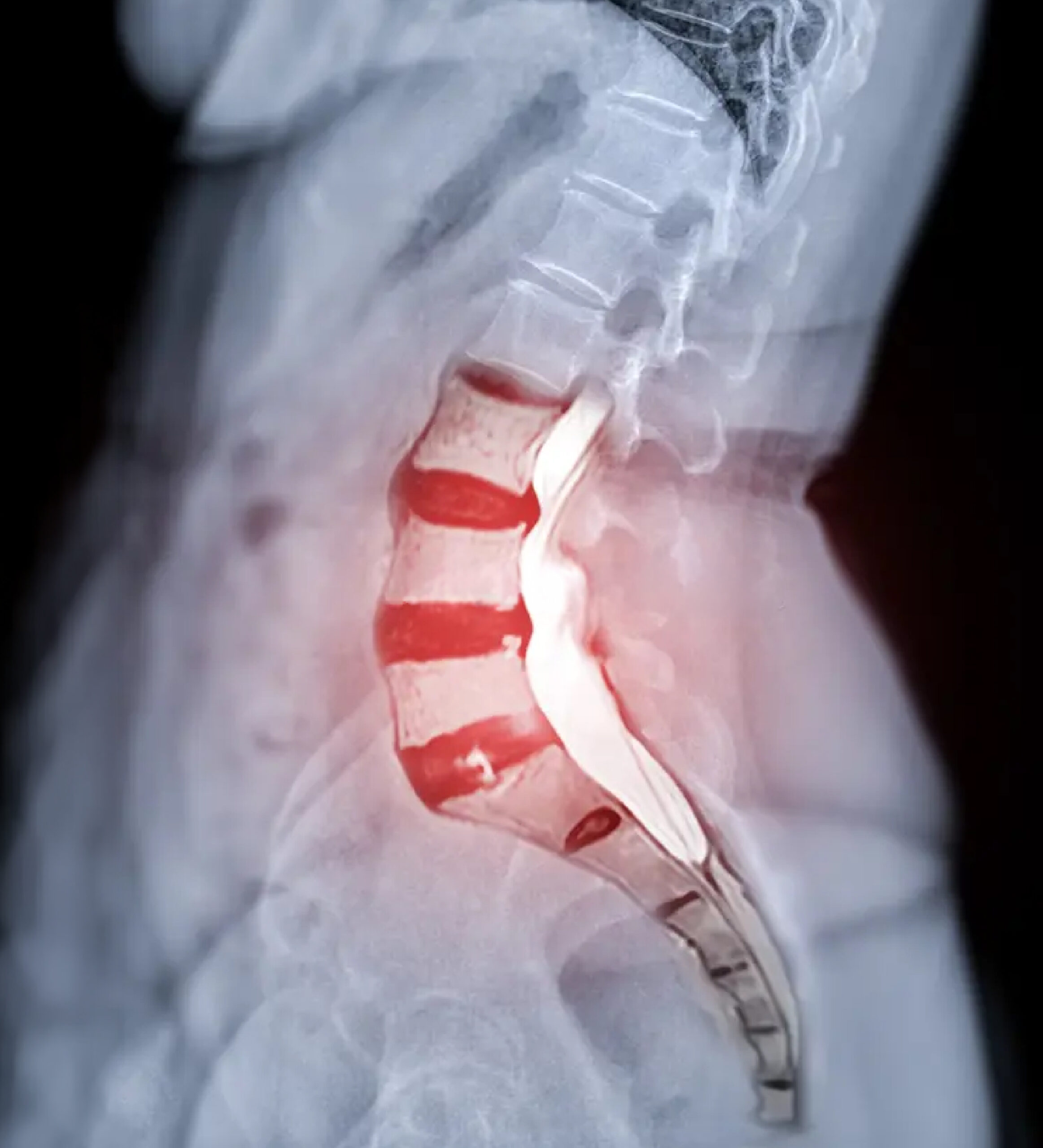 Radiografía de columna lumbar con proyecciones oblicuas