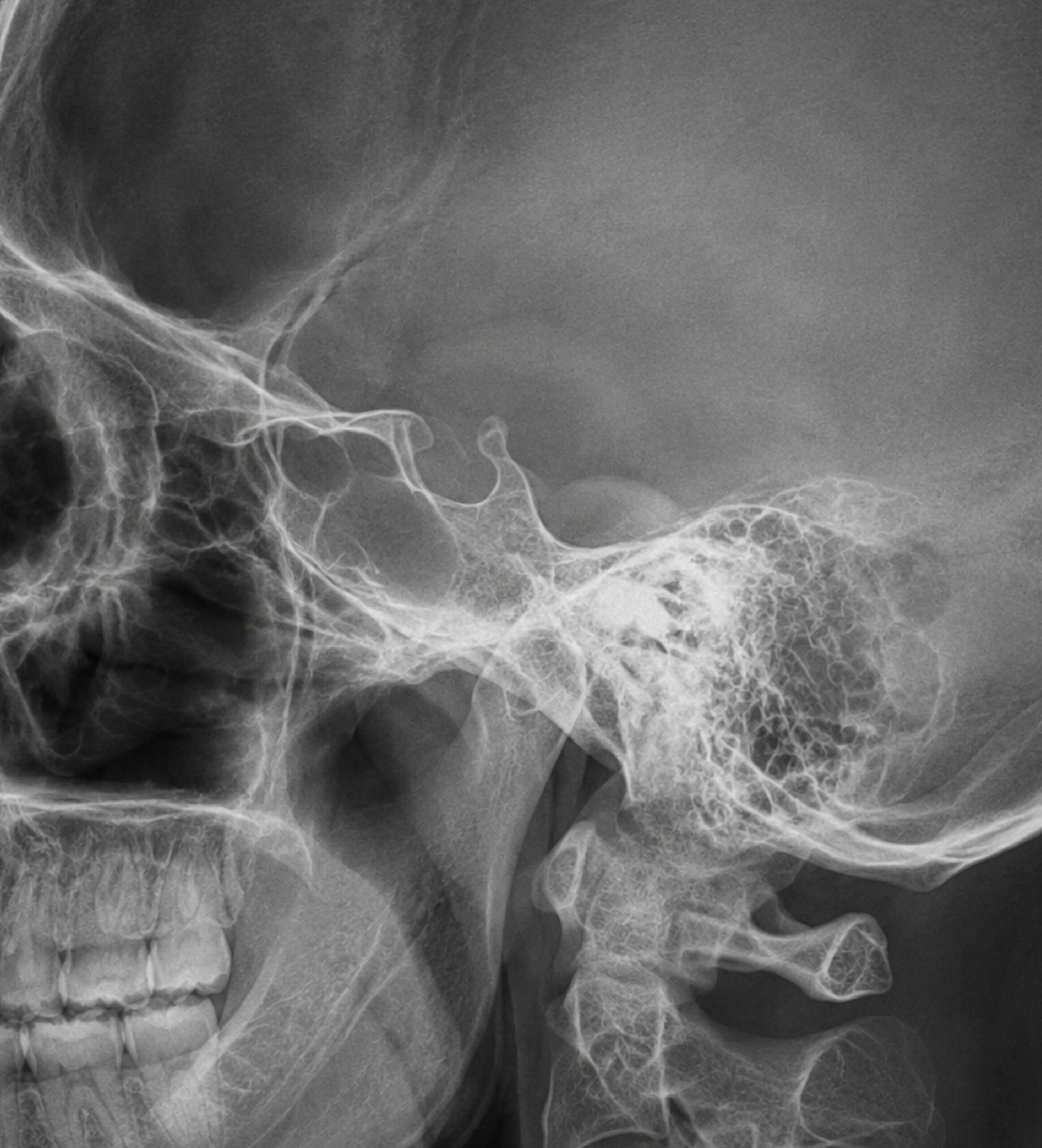 Radiografía de silla turca frontal y lateral