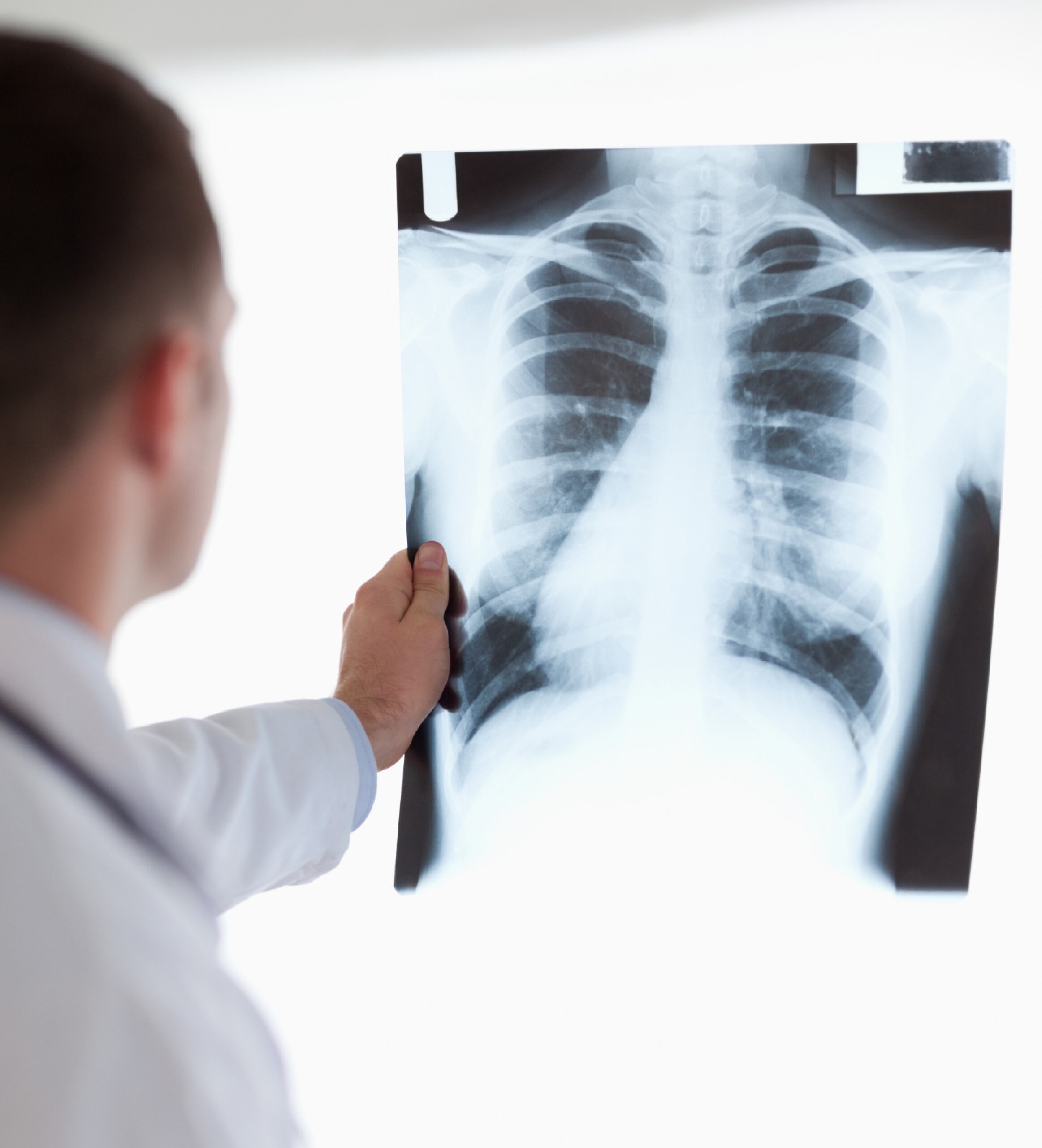 Proyección complementaria de una radiografía de tórax